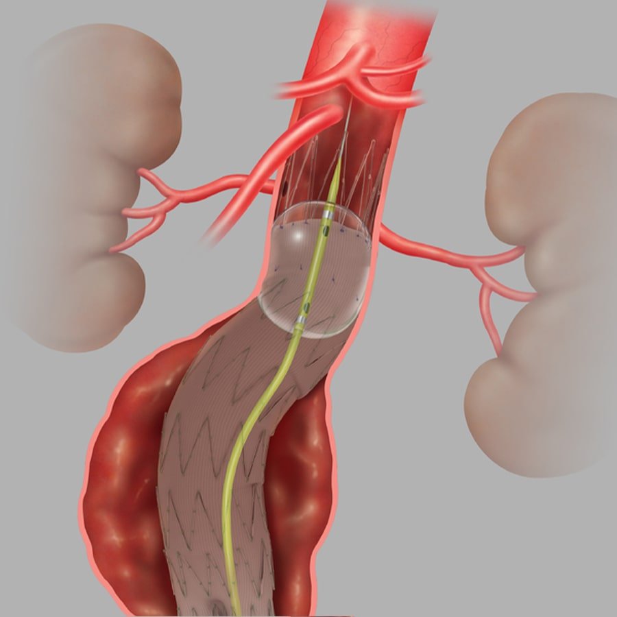 Coda-Balloon-Catheter-min