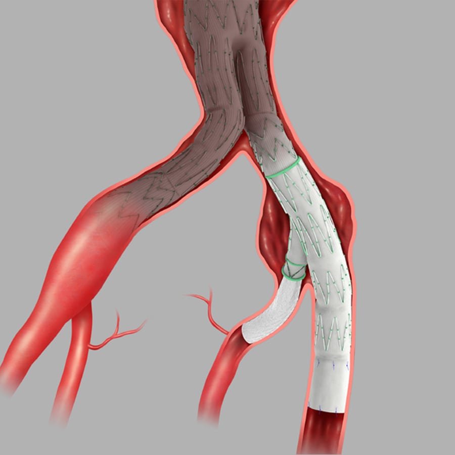 Zenith-Branch-Endovascular-Graft-Iliac-Bifurcation-min